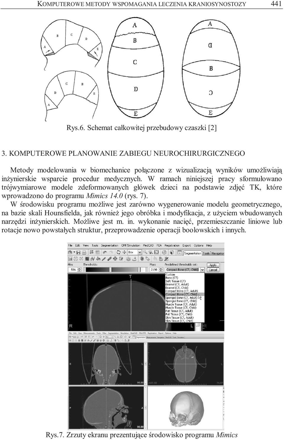 W ramach niniejszej pracy sformułowano trójwymiarowe modele zdeformowanych główek dzieci na podstawie zdjęć TK, które wprowadzono do programu Mimics 14.0 (rys. 7).