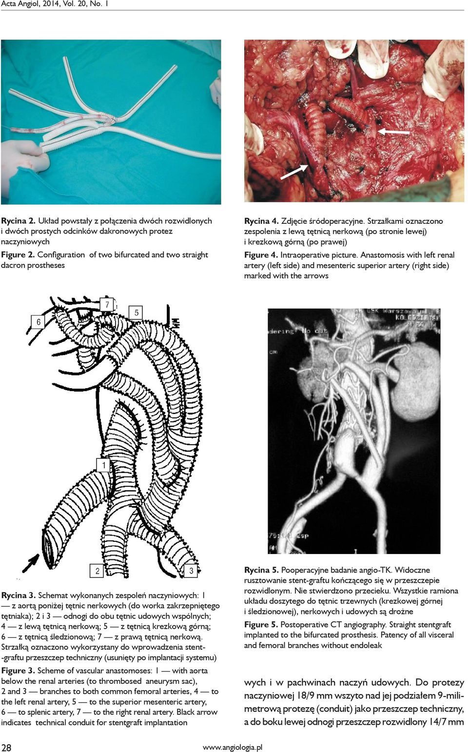 Strzałkami oznaczono zespolenia z lewą tętnicą nerkową (po stronie lewej) i krezkową górną (po prawej) Figure 4. Intraoperative picture.