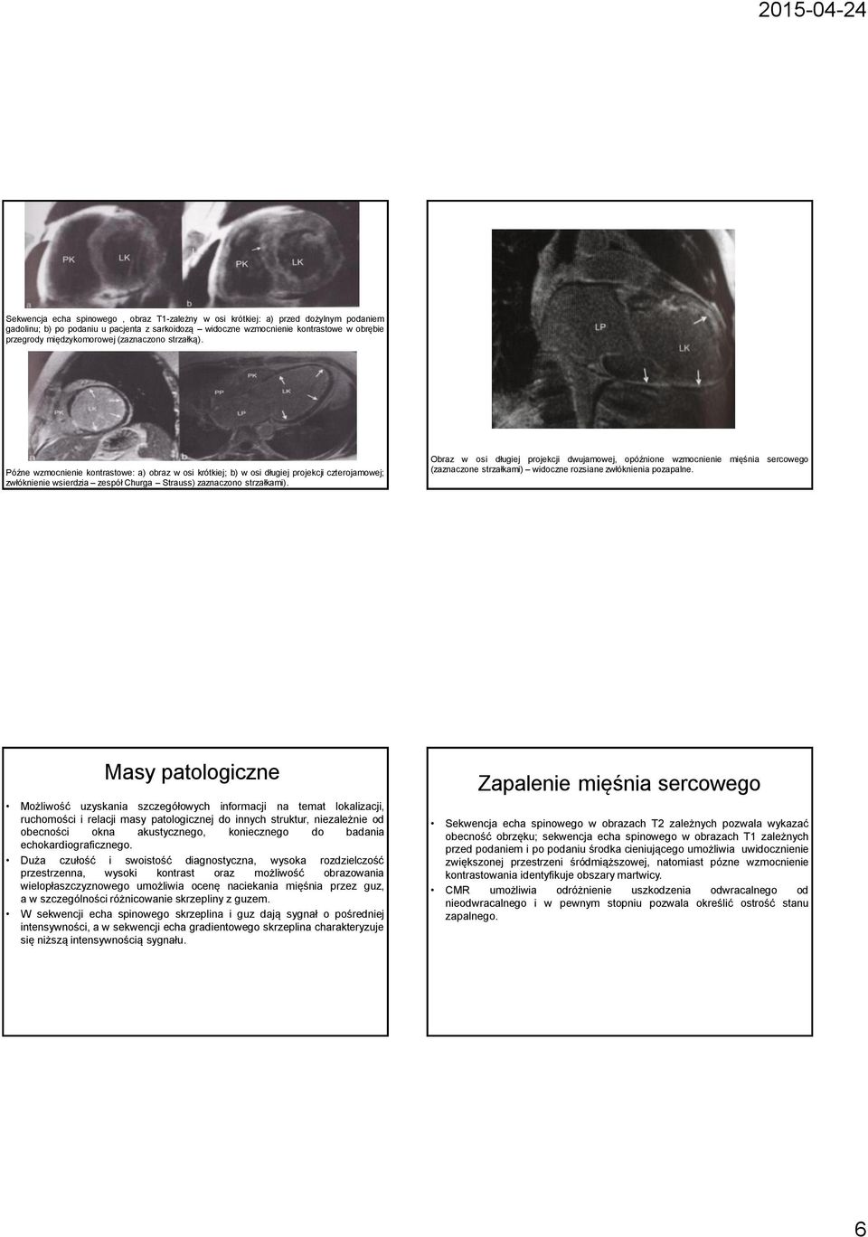 Późne wzmocnienie kontrastowe: a) obraz w osi krótkiej; b) w osi długiej projekcji czterojamowej; zwłóknienie wsierdzia zespół Churga Strauss) zaznaczono strzałkami).