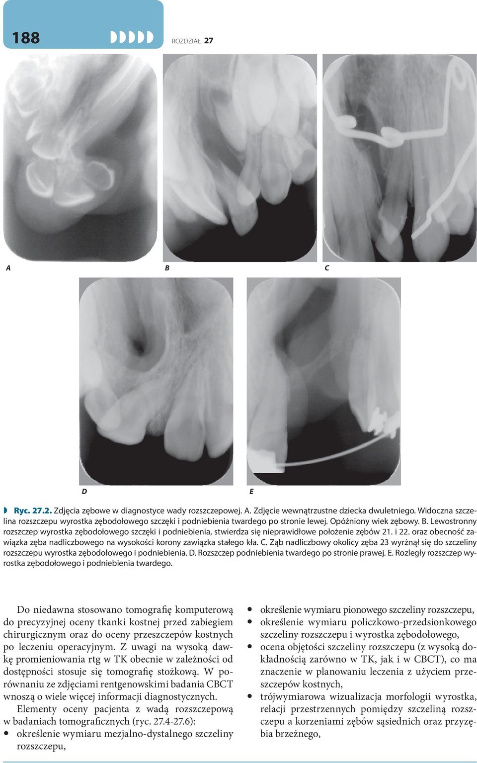 . Lewostronny rozszczep wyrostka zębodołowego szczęki i podniebienia, stwierdza się nieprawidłowe położenie zębów 21. i 22.