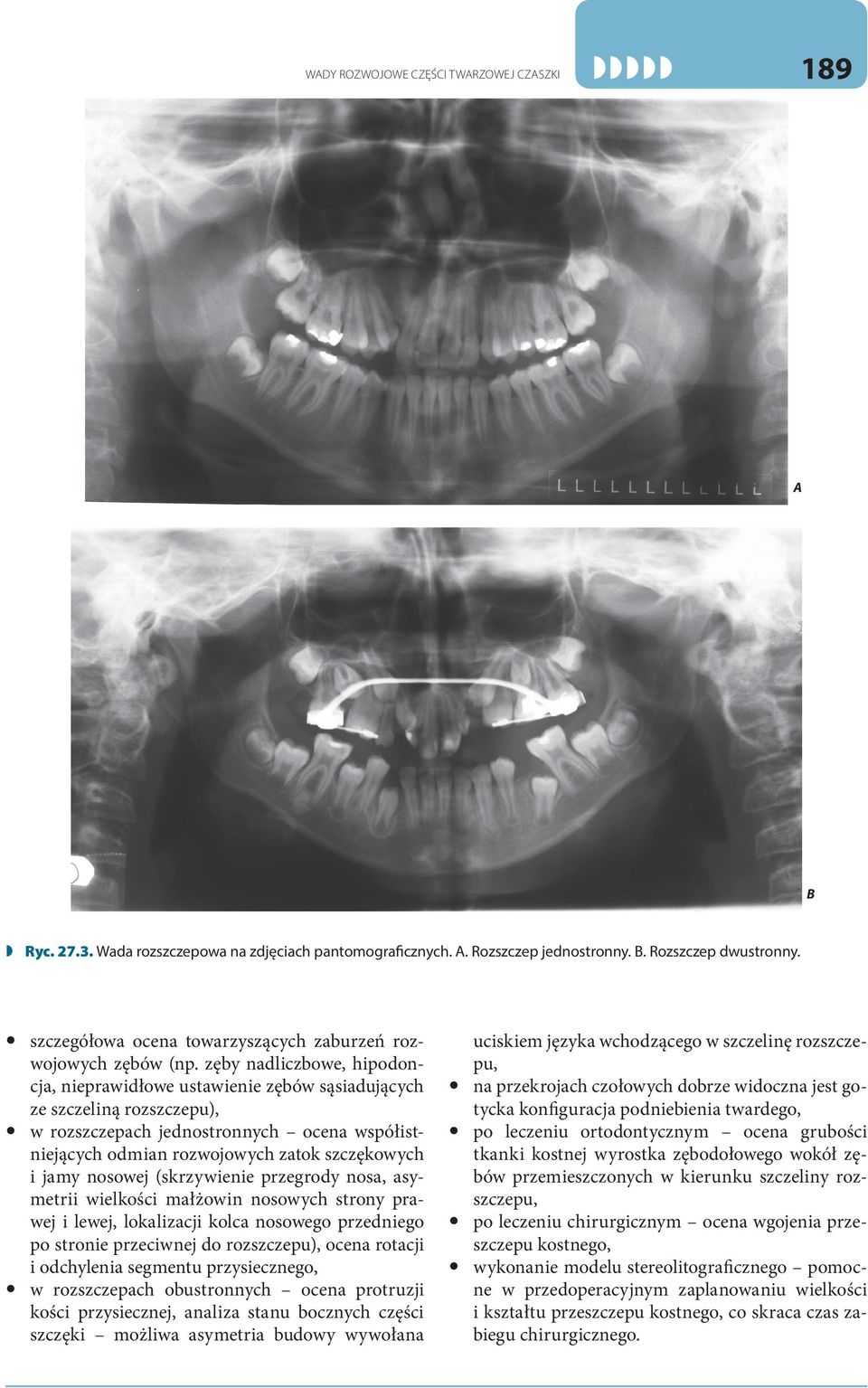 zęby nadliczbowe, hipodoncja, nieprawidłowe ustawienie zębów sąsiadujących ze szczeliną rozszczepu), w rozszczepach jednostronnych ocena współistniejących odmian rozwojowych zatok szczękowych i jamy