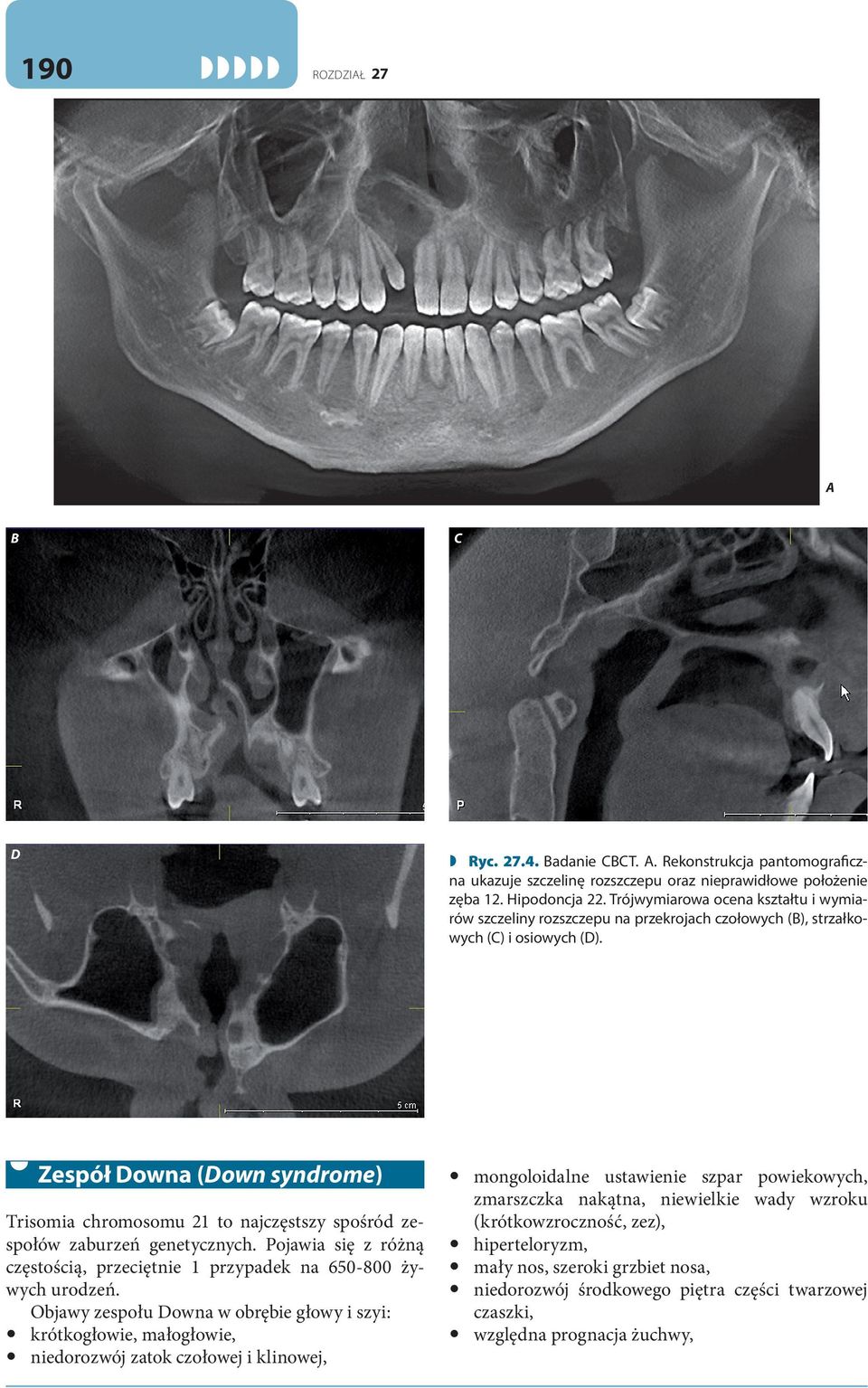 27.4. adanie CCT.. Rekonstrukcja pantomograficzna ukazuje szczelinę rozszczepu oraz nieprawidłowe położenie zęba 12. Hipodoncja 22.