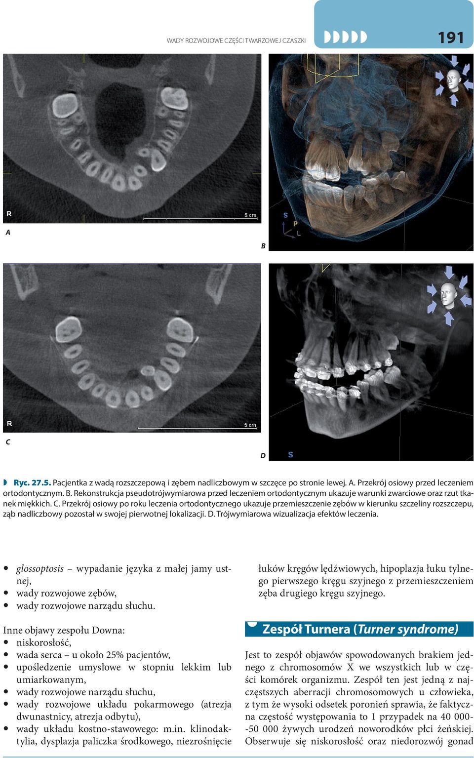 Przekrój osiowy po roku leczenia ortodontycznego ukazuje przemieszczenie zębów w kierunku szczeliny rozszczepu, ząb nadliczbowy pozostał w swojej pierwotnej lokalizacji. D.