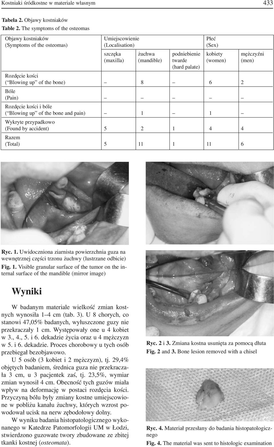 (men) (hard palate) Rozdęcie kości ( Blowing up of the bone) 8 6 2 Bóle (Pain) Rozdęcie kości i bóle ( Blowing up of the bone and pain) 1 1 Wykryte przypadkowo (Found by accident) 5 2 1 4 4 Razem