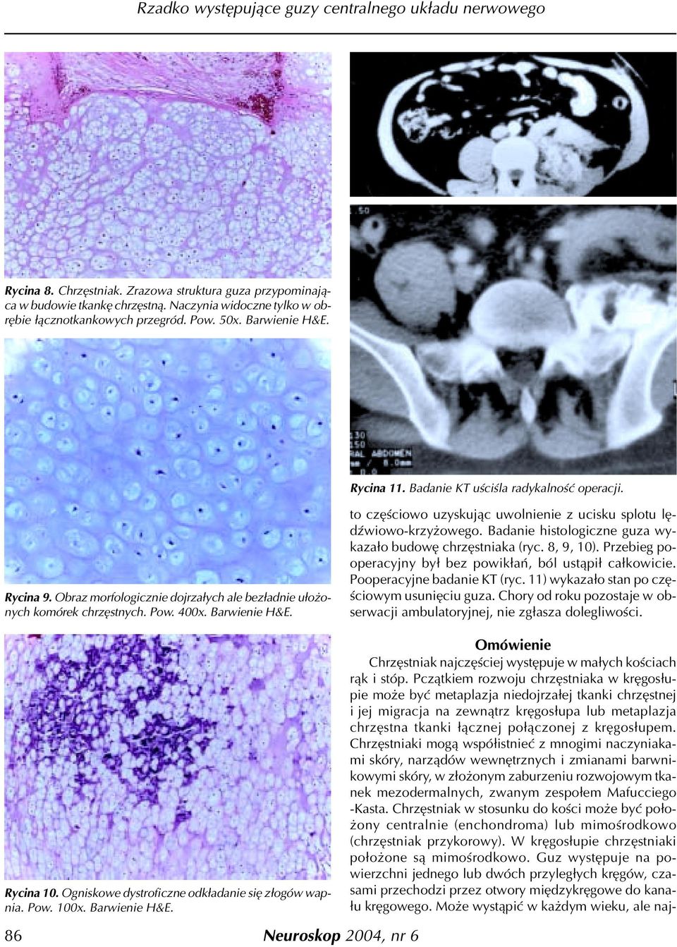 to czêœciowo uzyskuj¹c uwolnienie z ucisku splotu lêdÿwiowo-krzy owego. Badanie histologiczne guza wykaza³o budowê chrzêstniaka (ryc. 8, 9, 10).