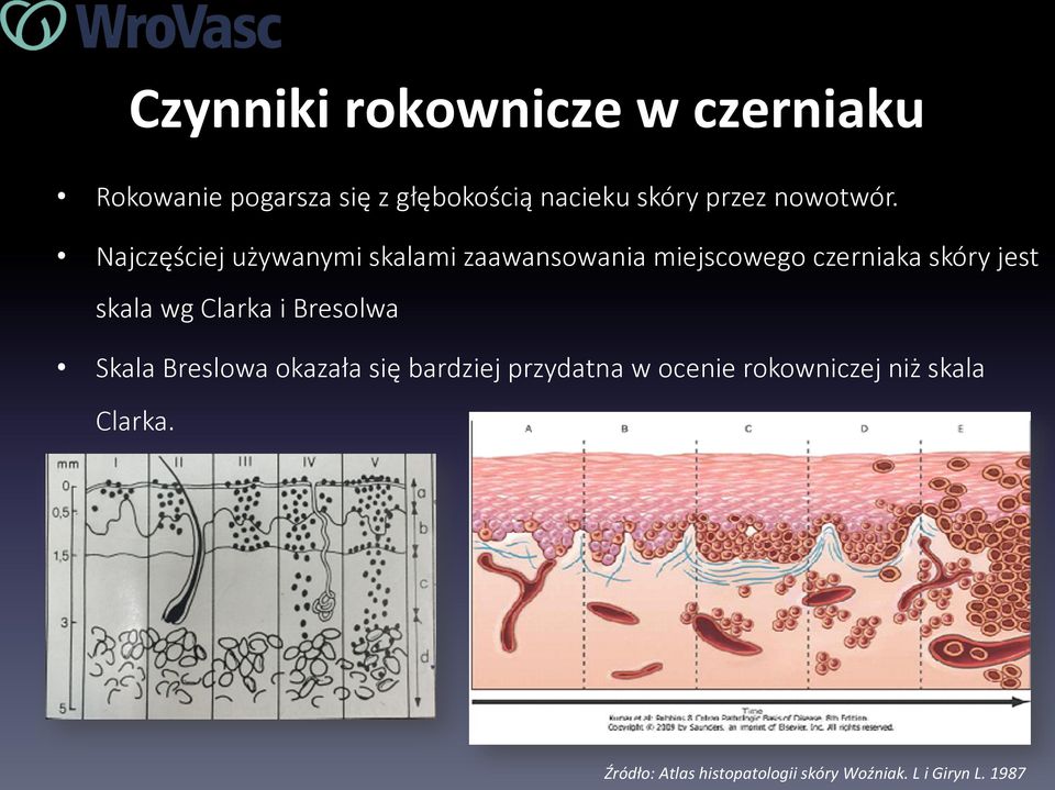 Najczęściej używanymi skalami zaawansowania miejscowego czerniaka skóry jest skala wg
