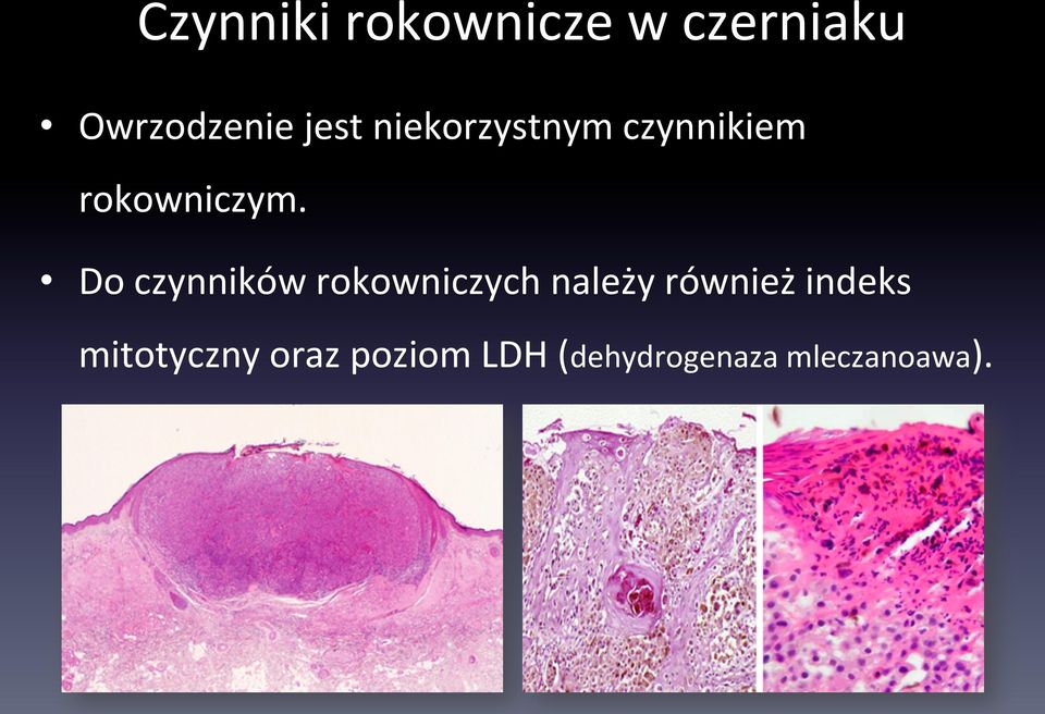 Do czynników rokowniczych należy również indeks