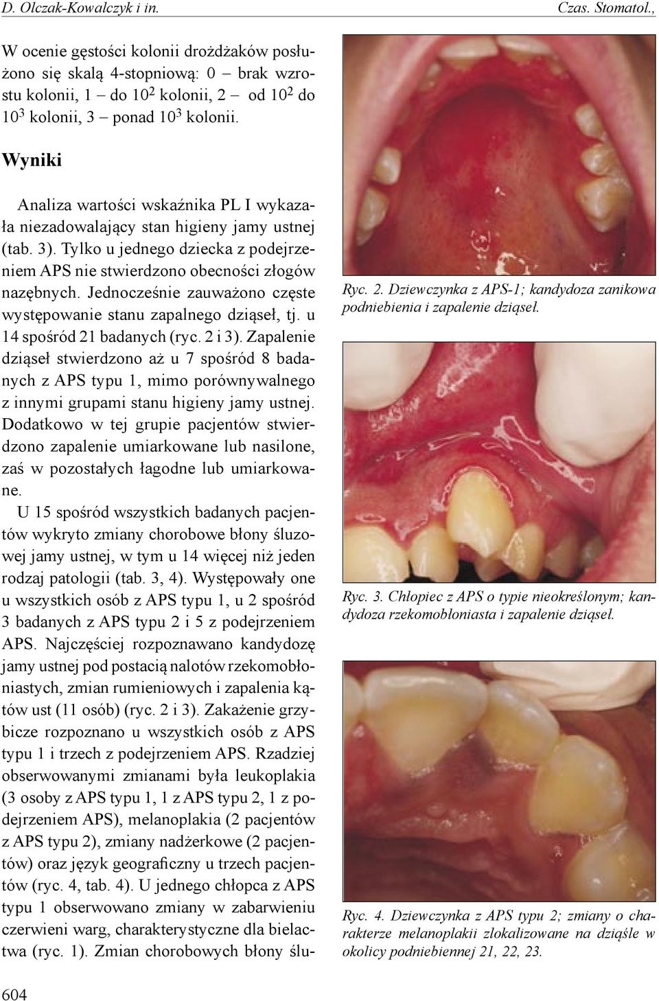 Wyniki Analiza wartości wskaźnika PL I wykazała niezadowalający stan higieny jamy ustnej (tab. 3). Tylko u jednego dziecka z podejrzeniem APS nie stwierdzono obecności złogów nazębnych.