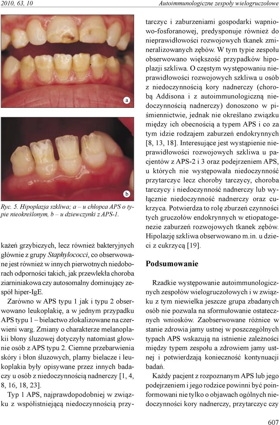 autosomalny dominujący zespół hiper-ige. Zarówno w APS typu 1 jak i typu 2 obserwowano leukoplakię, a w jednym przypadku APS typu 1 bielactwo zlokalizowane na czerwieni warg.