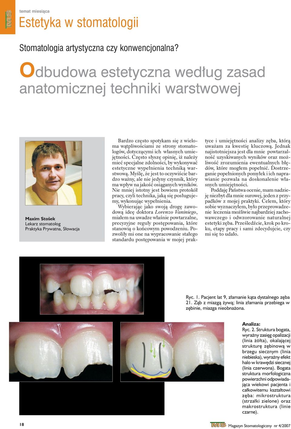 stomatologów, dotycz¹cymi ich w³asnych umiejêtnoœci. Czêsto s³yszê opiniê, i nale y mieæ specjalne zdolnoœci, by wykonywaæ estetyczne wype³nienia technik¹ warstwow¹.