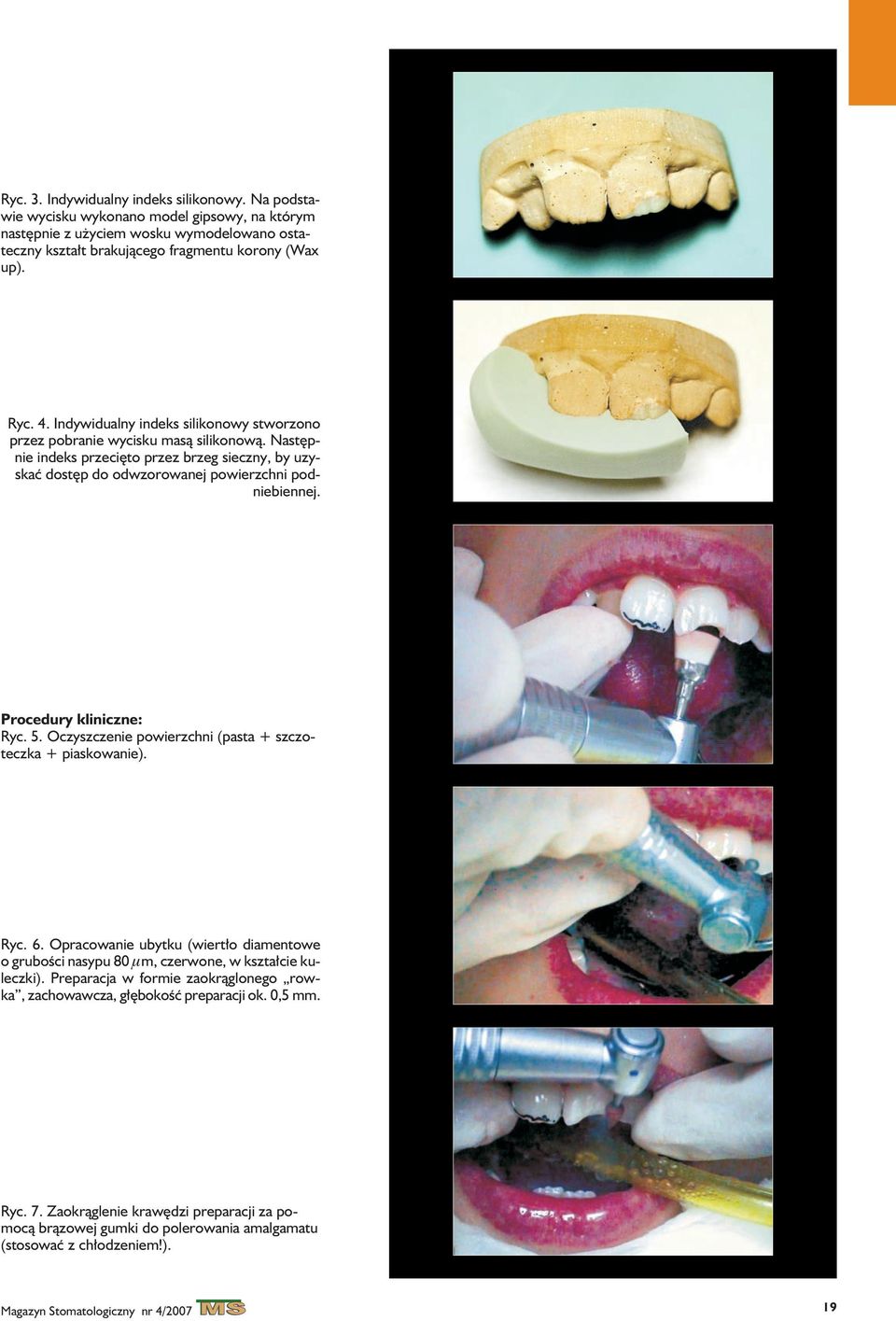 Procedury kliniczne: Ryc. 5. Oczyszczenie powierzchni (pasta + szczoteczka + piaskowanie). Ryc. 6. Opracowanie ubytku (wiert³o diamentowe o gruboœci nasypu 80 mm, czerwone, w kszta³cie kuleczki).