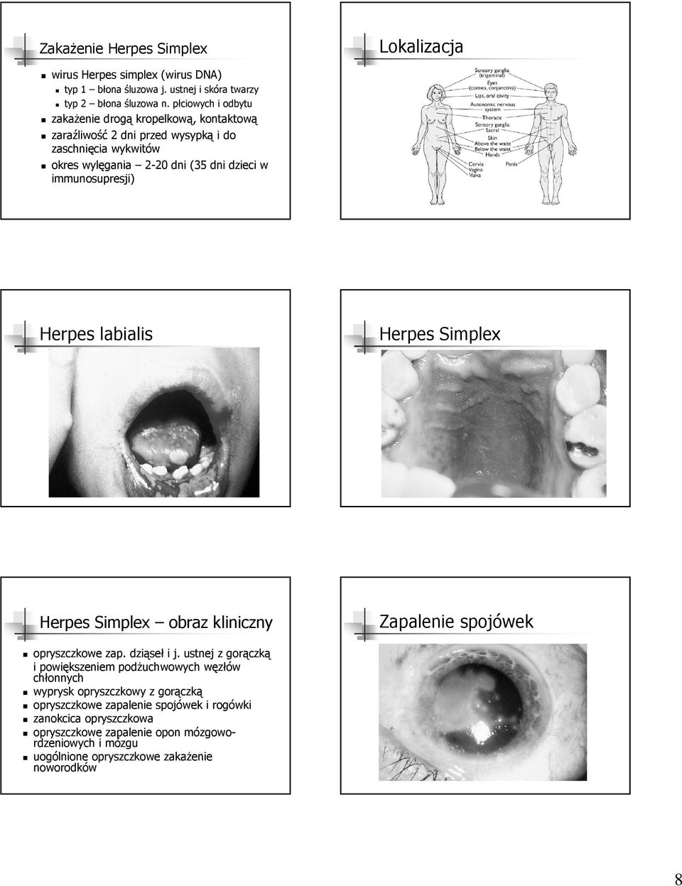 immunosupresji) Herpes labialis Herpes Simplex Herpes Simplex obraz kliniczny Zapalenie spojówek opryszczkowe zap. dziąseł i j.