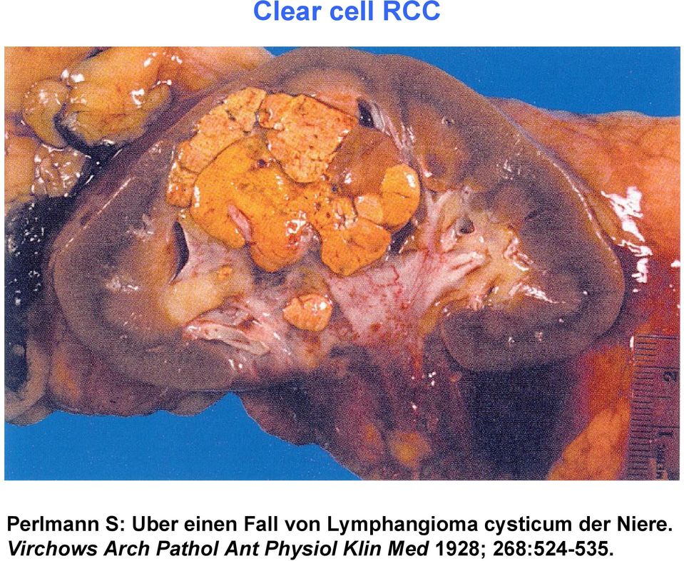 cysticum der Niere.