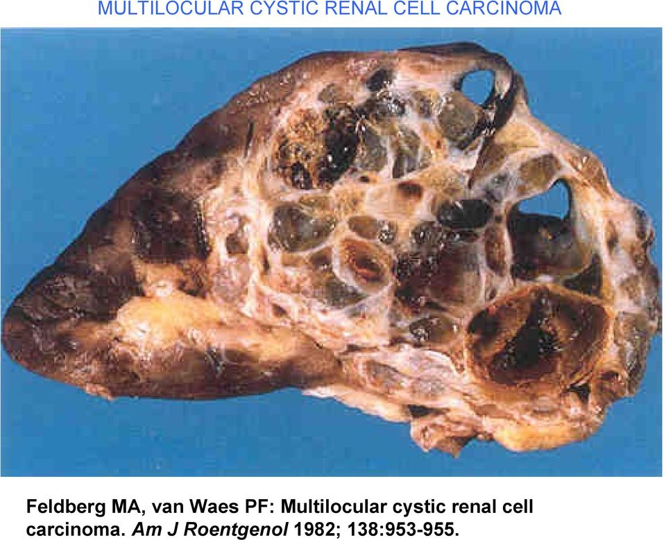 Multilocular cystic renal cell