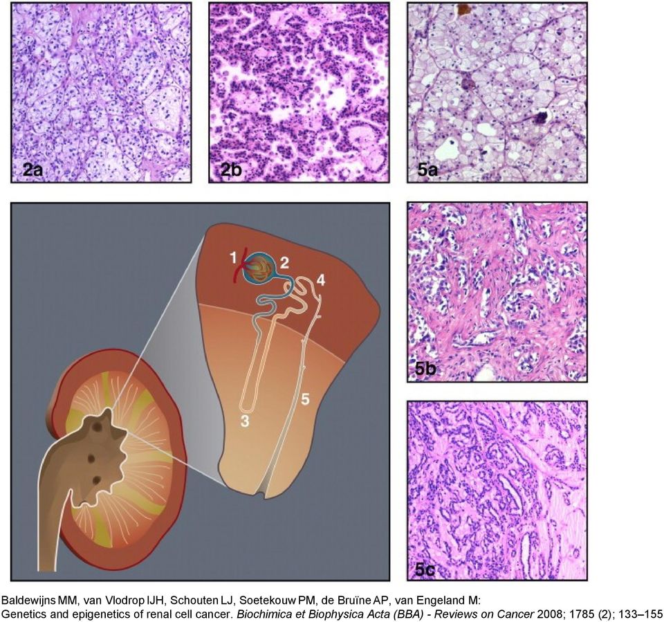 and epigenetics of renal cell cancer.