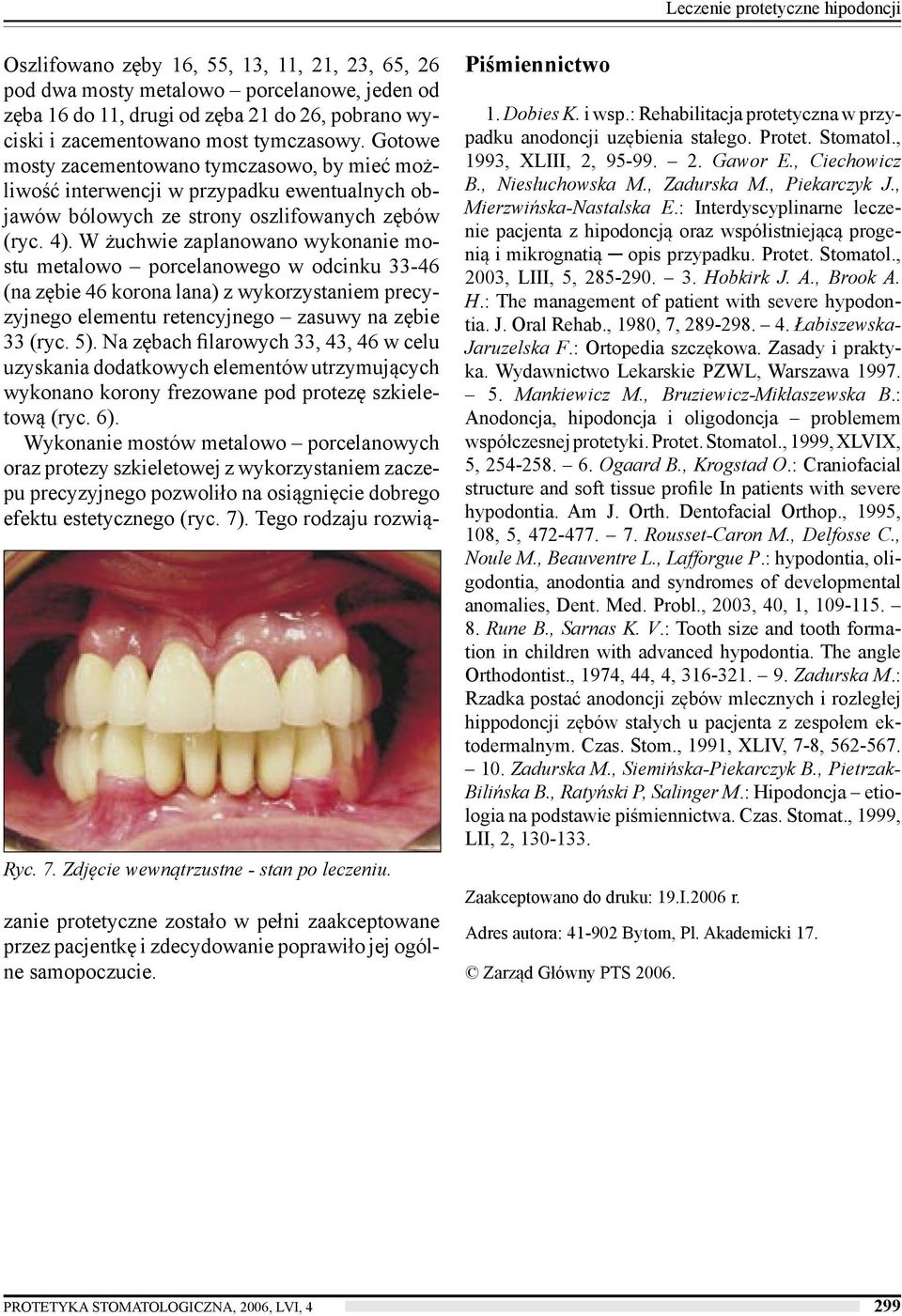 Gotowe mosty zacementowano tymczasowo, by mieć możliwość interwencji w przypadku ewentualnych objawów bólowych ze strony oszlifowanych zębów (ryc. 4).