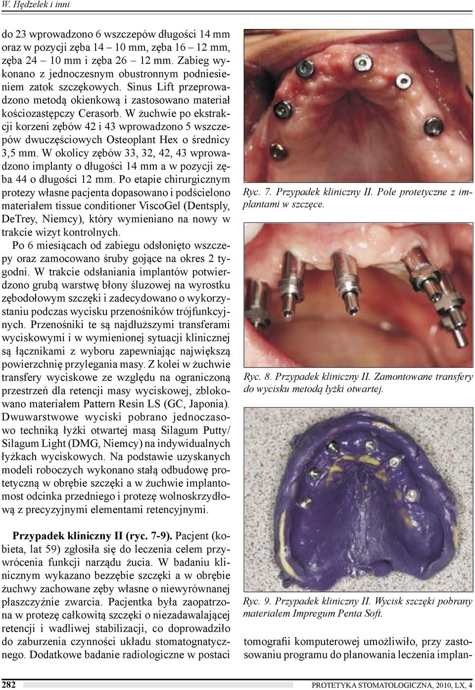 W żuchwie po ekstrakcji korzeni zębów 42 i 43 wprowadzono 5 wszczepów dwuczęściowych Osteoplant Hex o średnicy 3,5 mm.