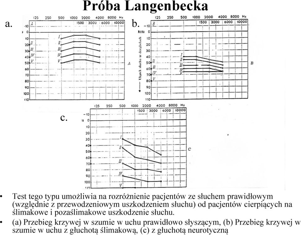 przewodzeniowym uszkodzeniem słuchu) od pacjentów cierpiących ą na ślimakowe i pozaślimakowe