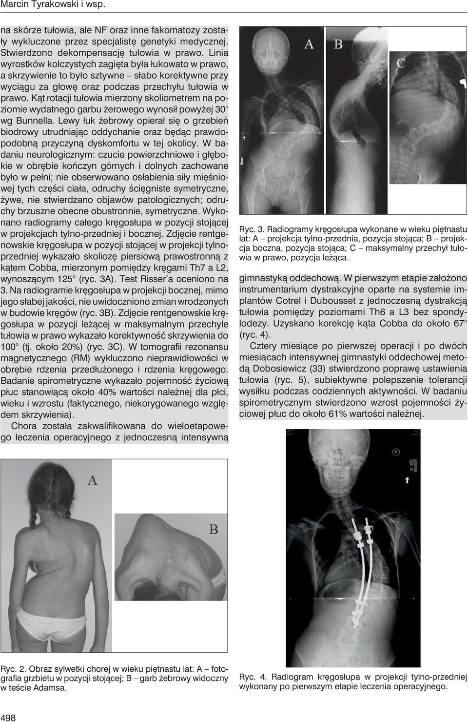 Kąt rotacji tułowia mierzony skoliometrem na poziomie wydatnego garbu żerowego wynosił powyżej 30 wg Bunnella.