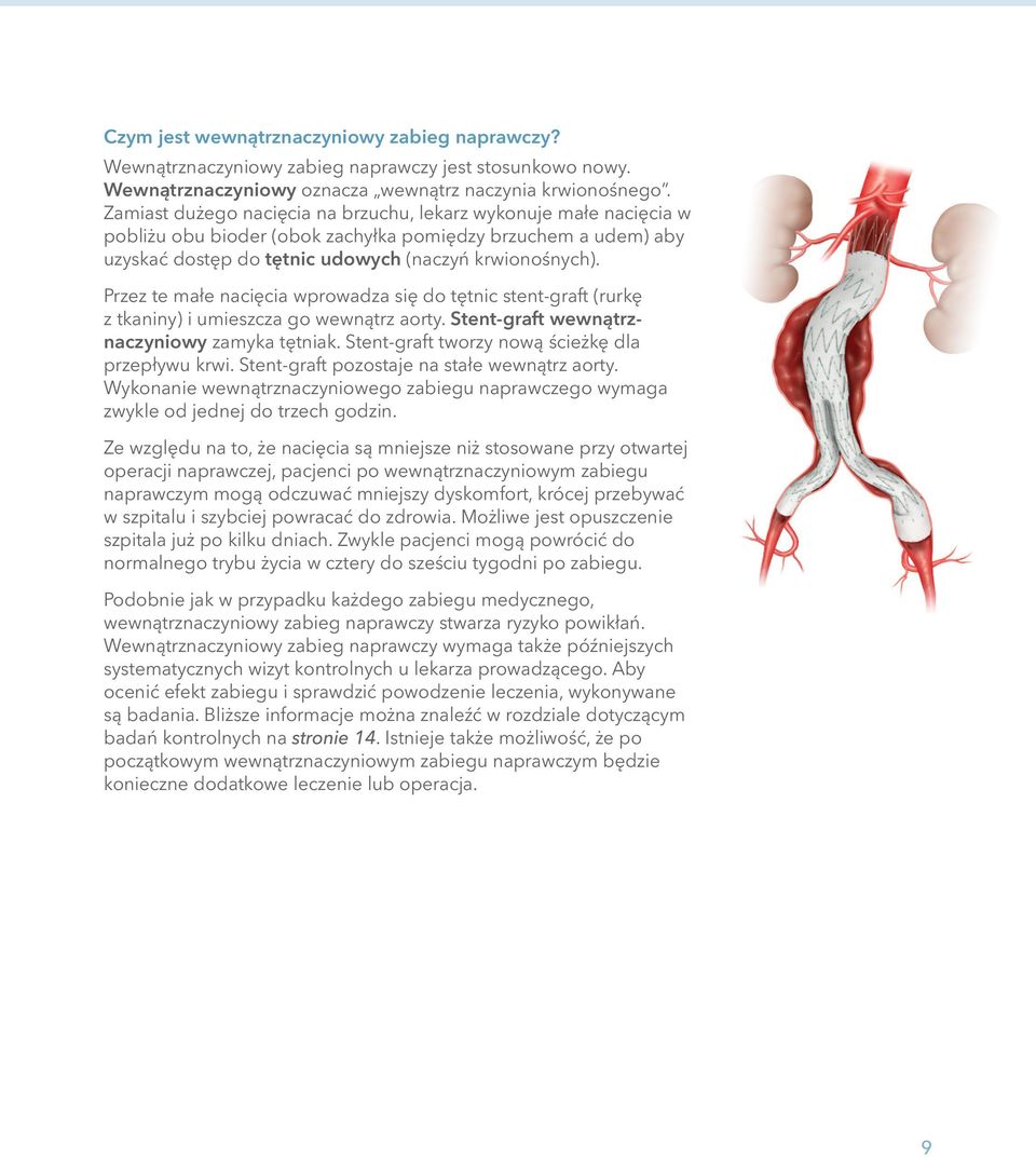 Przez te małe nacięcia wprowadza się do tętnic stent-graft (rurkę z tkaniny) i umieszcza go wewnątrz aorty. Stent-graft wewnątrznaczyniowy zamyka tętniak.