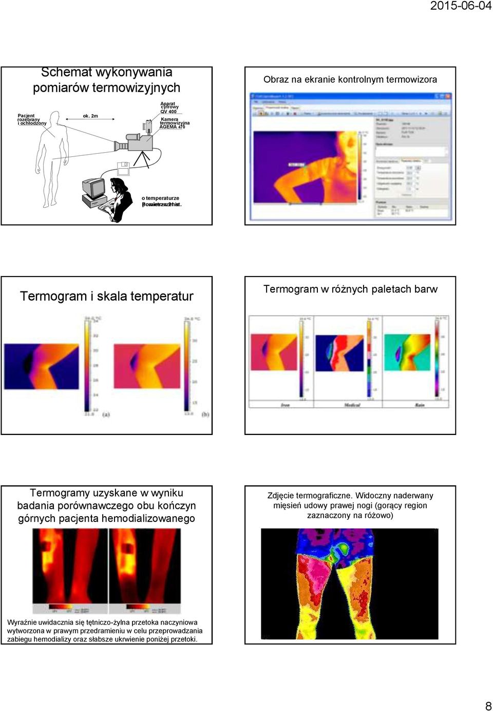 Termogram i skala temperatur Termogram w różnych paletach barw Termogramy uzyskane w wyniku badania porównawczego obu kończyn górnych pacjenta hemodializowanego