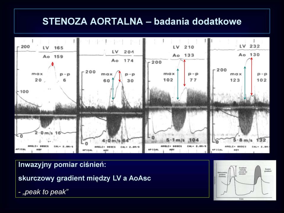 ciśnień: skurczowy gradient