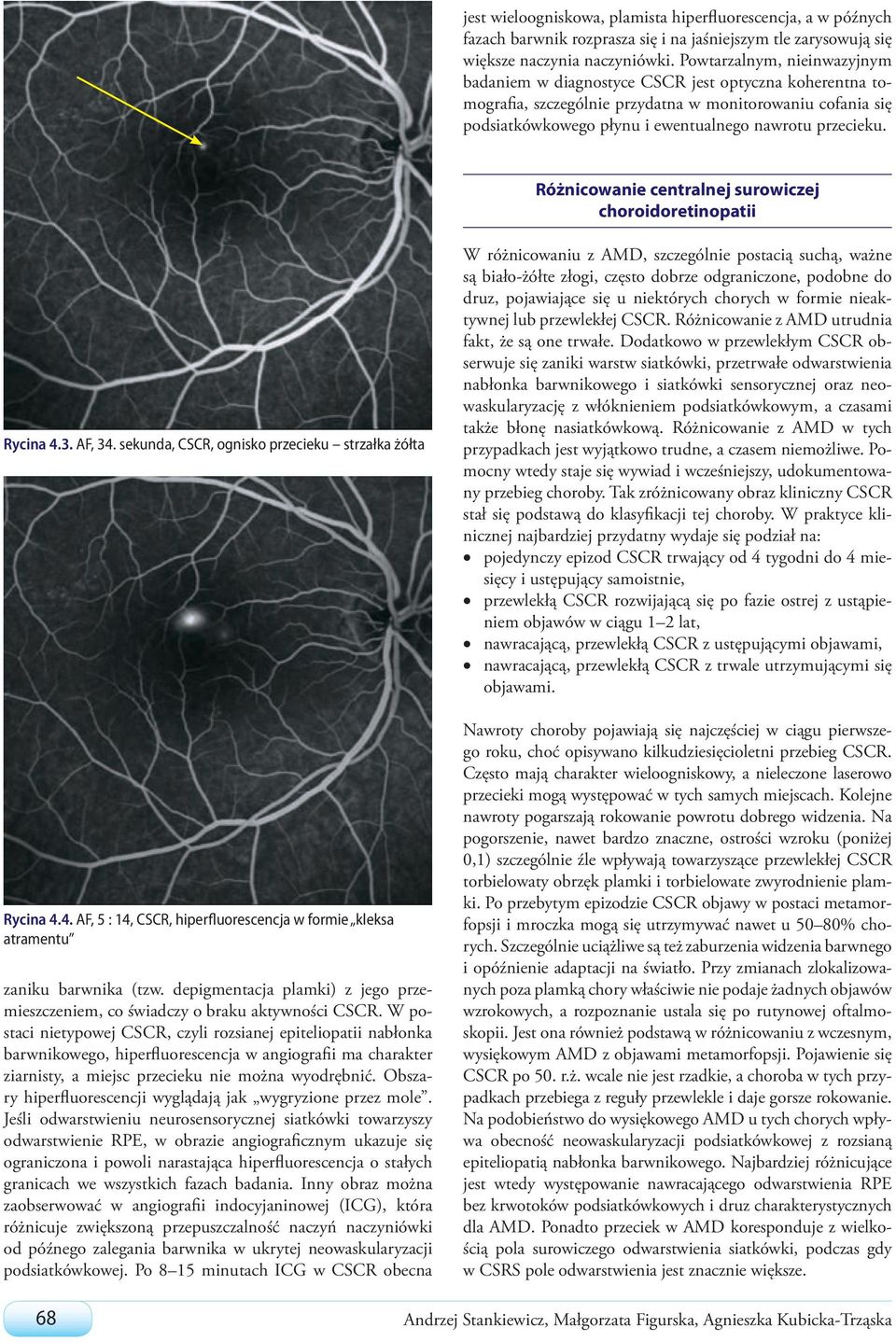 Różnicowanie centralnej surowiczej choroidoretinopatii Rycina 4.3. AF, 34. sekunda, CSCR, ognisko przecieku strzałka żółta Rycina 4.4. AF, 5 : 14, CSCR, hiperfluorescencja w formie kleksa atramentu zaniku barwnika (tzw.