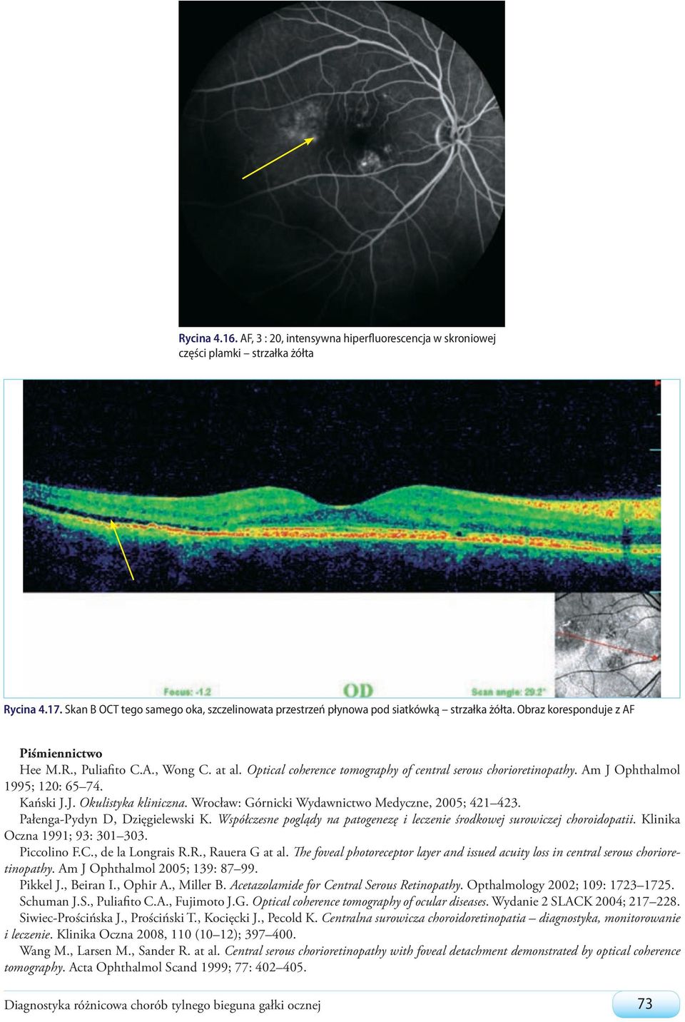 Wrocław: Górnicki Wydawnictwo Medyczne, 2005; 421 423. Pałenga-Pydyn D, Dzięgielewski K. Współczesne poglądy na patogenezę i leczenie środkowej surowiczej choroidopatii.
