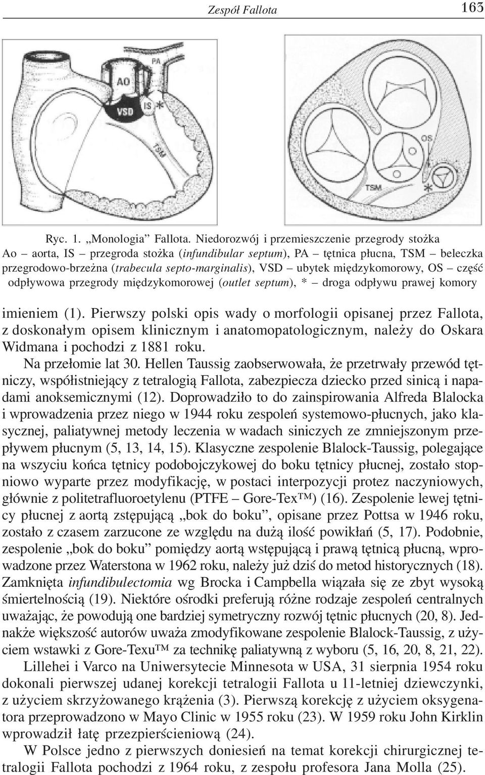 miêdzykomorowy, OS czêœæ odp³ywowa przegrody miêdzykomorowej (outlet septum), * droga odp³ywu prawej komory imieniem (1).