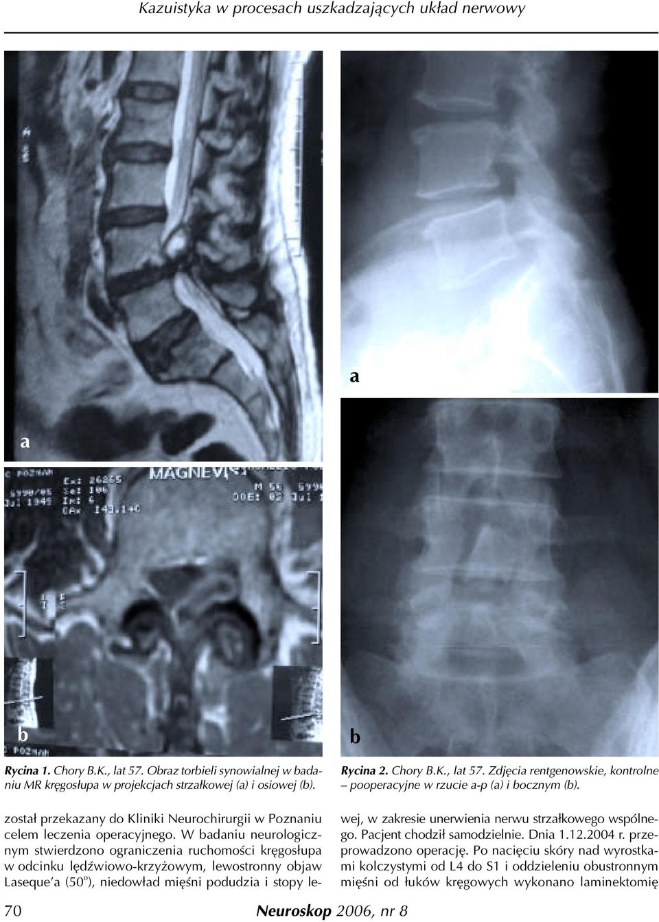 W dniu neurologicznym stwierdzono ogrniczeni ruchomoœci krêgos³up w odcinku lêdÿwiowo-krzy owym, lewostronny ojw Lseque (50 o ), niedow³d miêœni podudzi i stopy le- Rycin 2. Chory B.