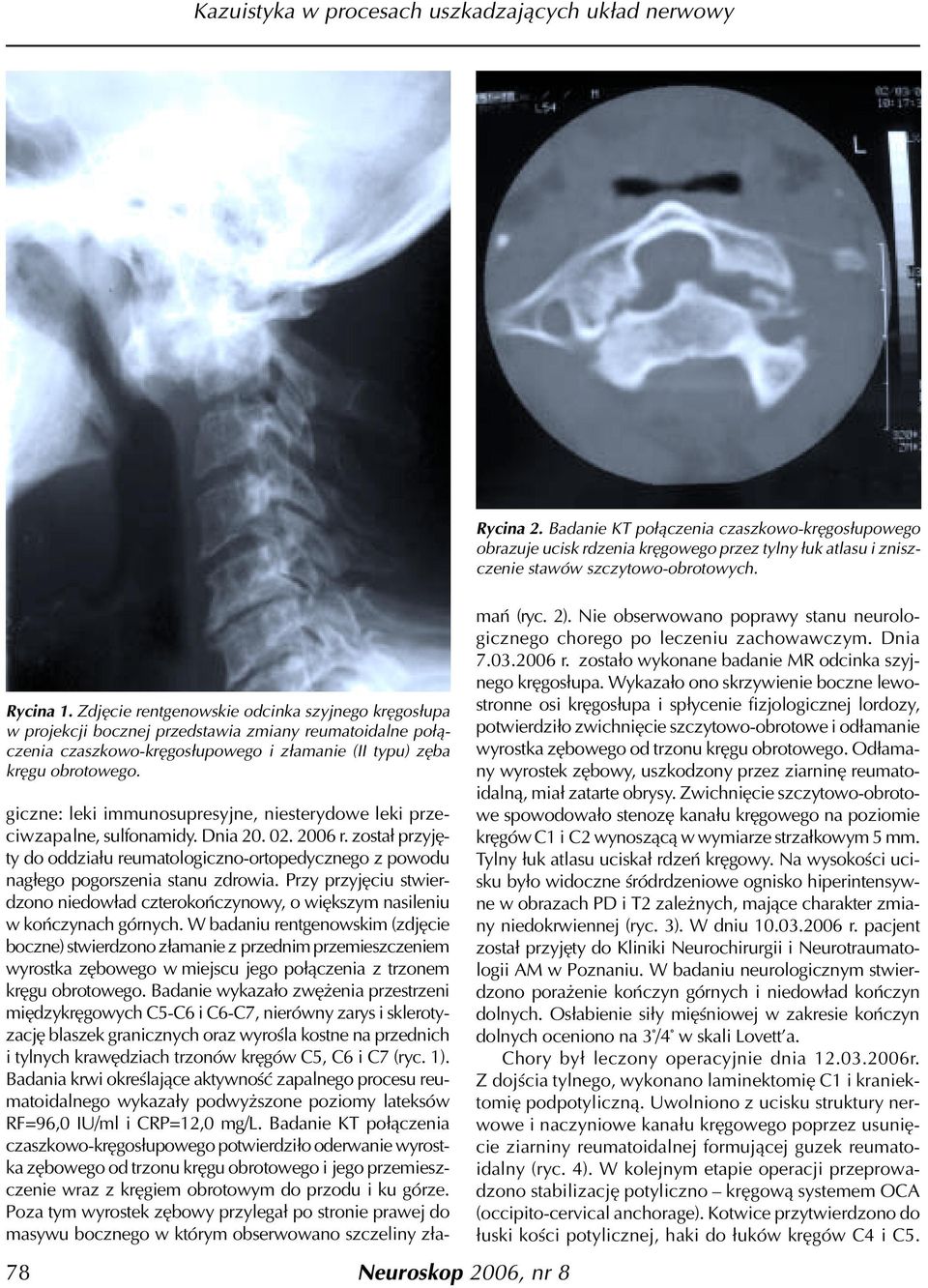 giczne: leki immunosupresyjne, niesterydowe leki przeciwzapalne, sulfonamidy. Dnia 20. 02. 2006 r.