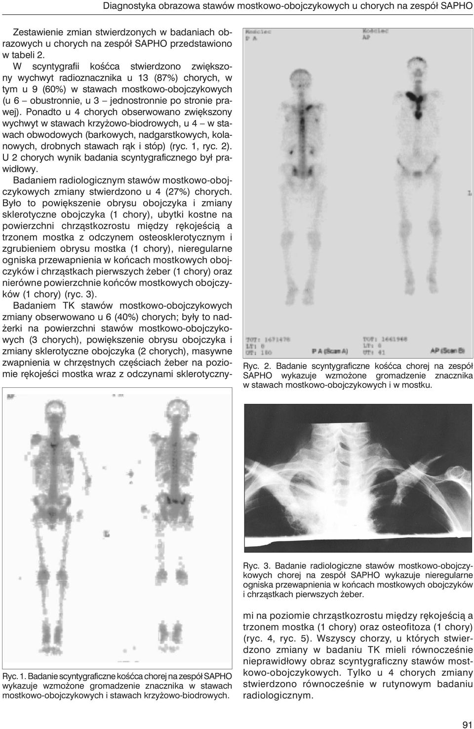 Badanie radiologiczne stawów mostkowo-obojczykowych chorej na zespół SAPHO wykazuje nieregularne ogniska przewapnienia w końcach mostkowych obojczyków i chrząstkach pierwszych żeber. Ryc. 1.