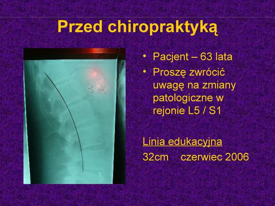 zmiany patologiczne w rejonie L5