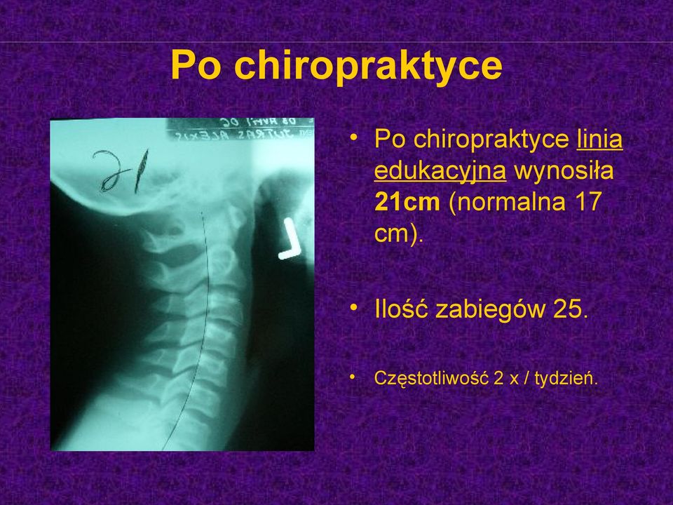 wynosiła 21cm (normalna 17 cm).