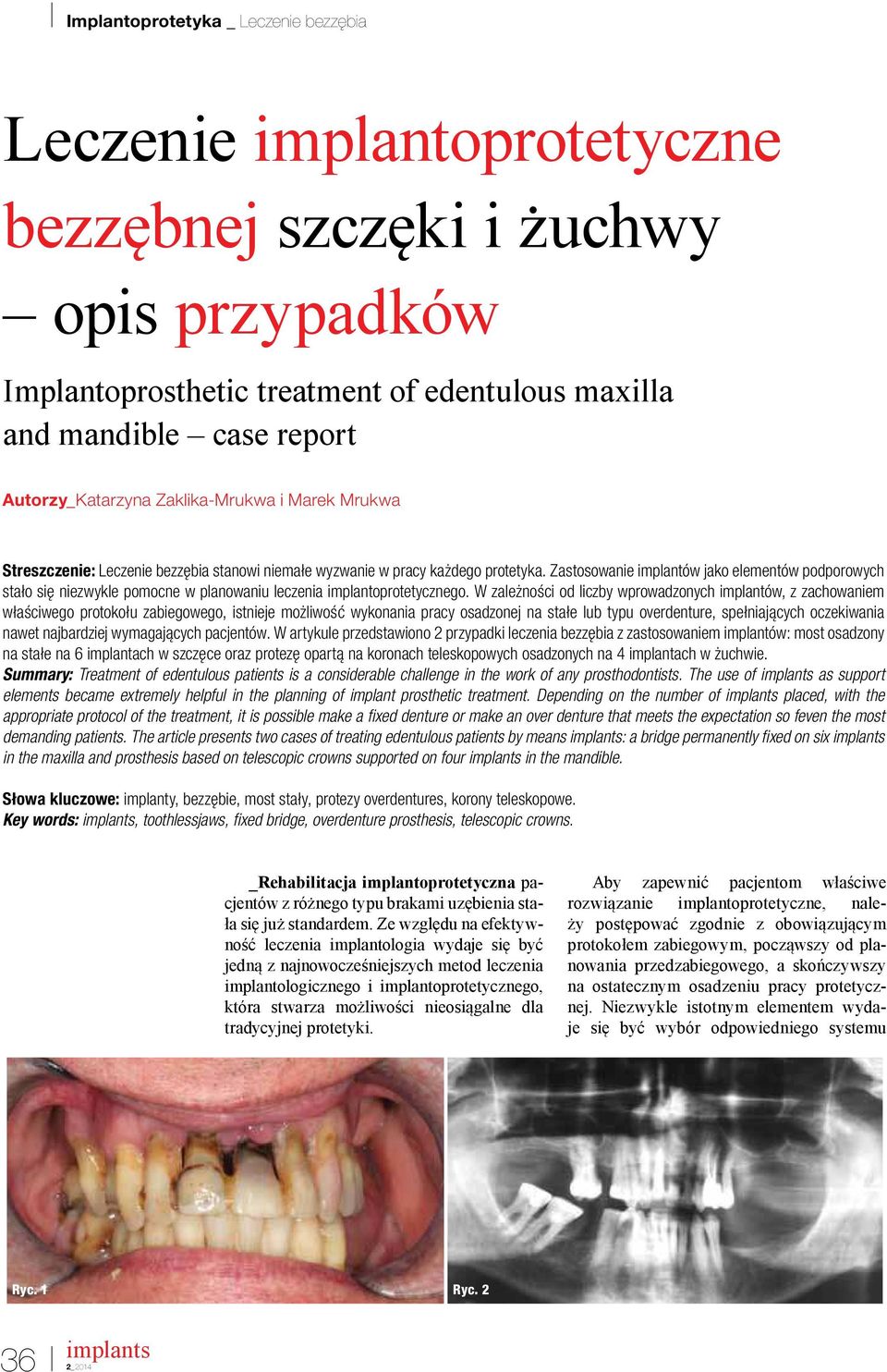 Zastosowanie implantów jako elementów podporowych stało się niezwykle pomocne w planowaniu leczenia implantoprotetycznego.