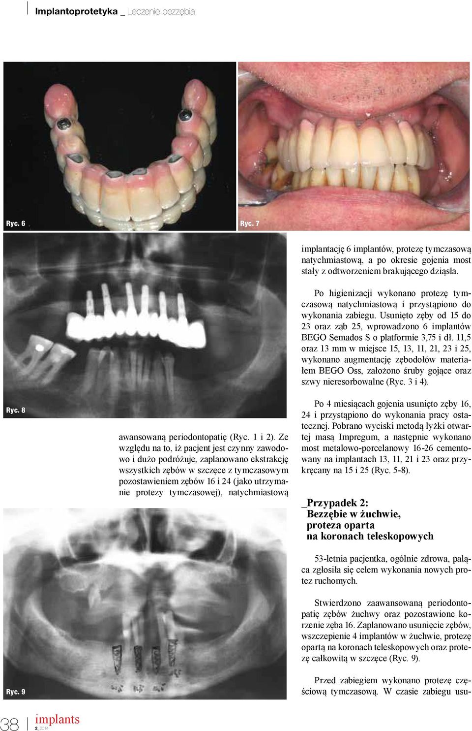 natychmiastową implantację 6 implantów, protezę tymczasową natychmiastową, a po okresie gojenia most stały z odtworzeniem brakującego dziąsła.
