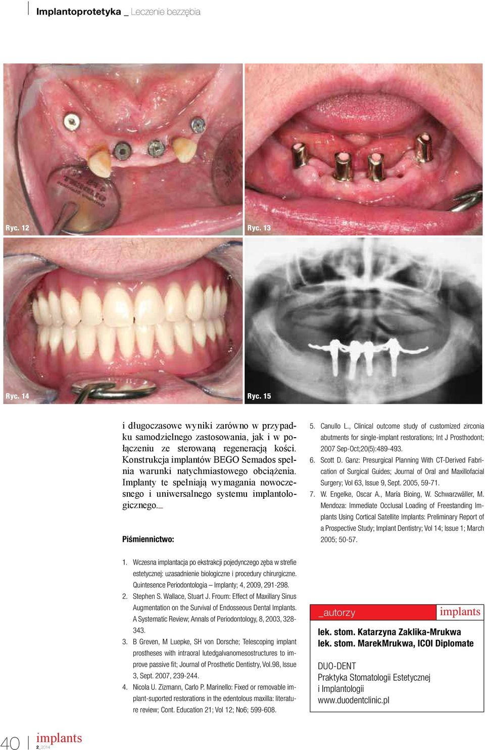 , Clinical outcome study of customized zirconia abutments for single-implant restorations; Int J Prosthodont; 2007 Sep-Oct;20(5):489-493. 6. Scott D.