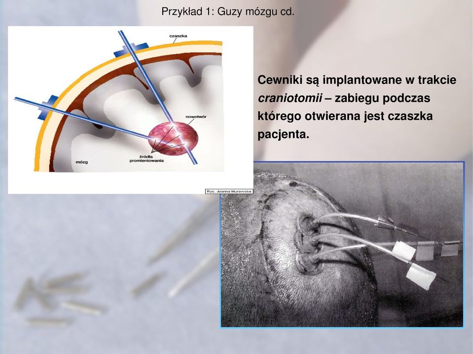 trakcie craniotomii zabiegu