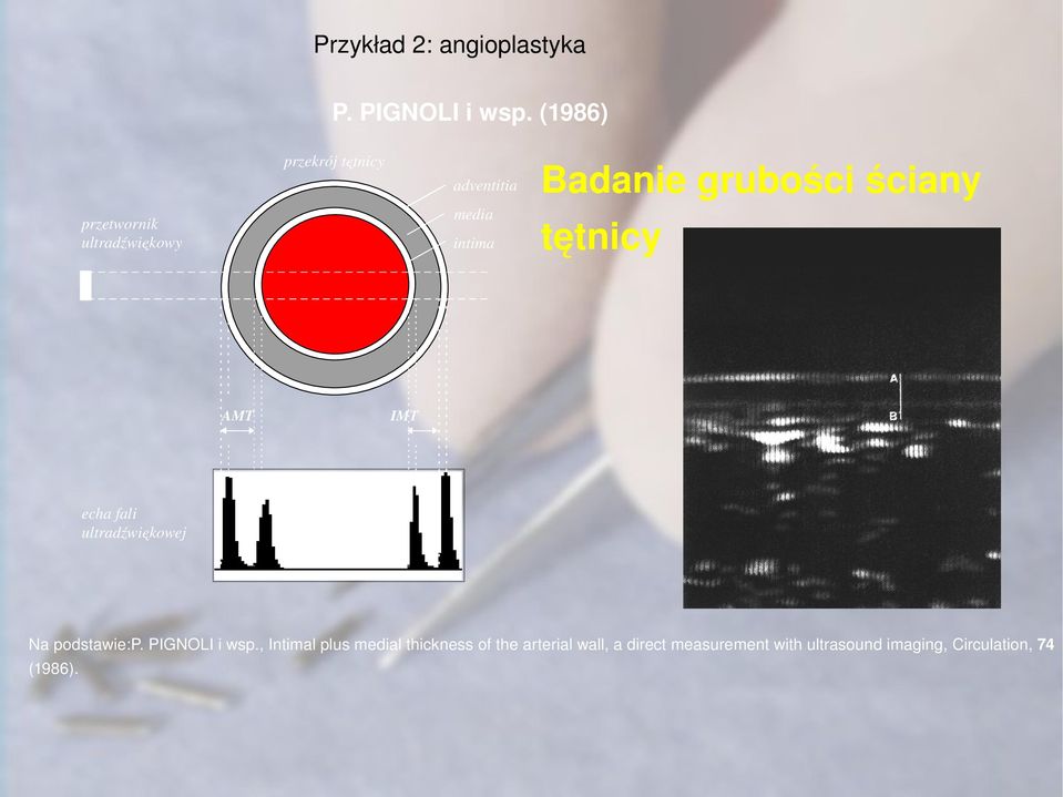grubości ściany tętnicy AMT IMT echa fali ultradźwiękowej Na podstawie:p.