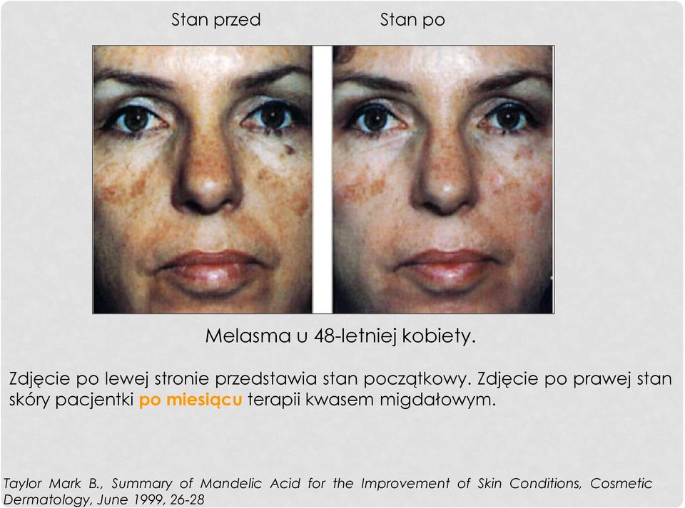 Zdjęcie po prawej stan skóry pacjentki po miesiącu terapii kwasem