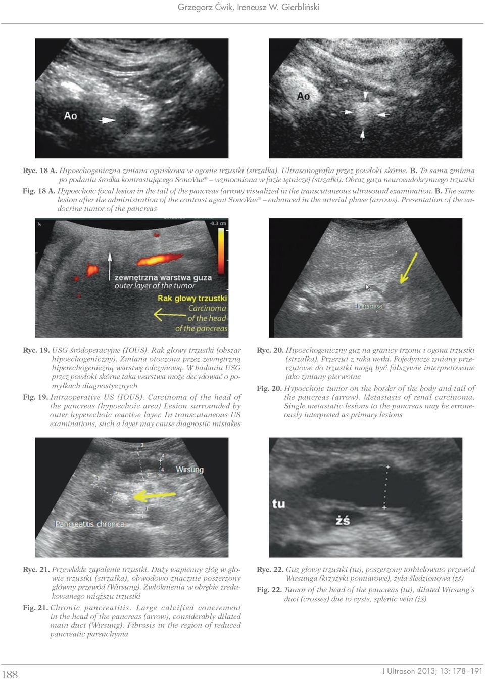Hypoechoic focal lesion in the tail of the pancreas (arrow) visualized in the transcutaneous ultrasound examination. B.