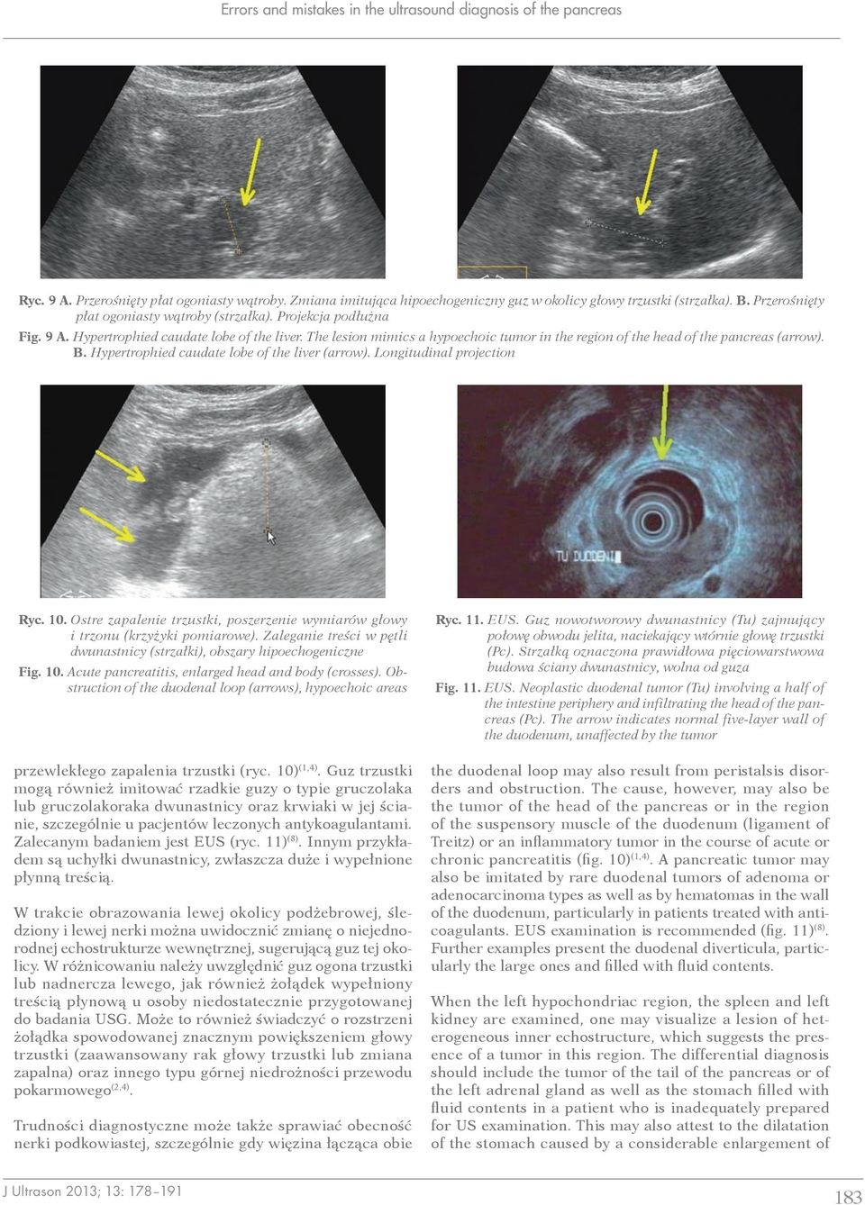 The lesion mimics a hypoechoic tumor in the region of the head of the pancreas (arrow). B. Hypertrophied caudate lobe of the liver (arrow). Longitudinal projection Ryc. 10.
