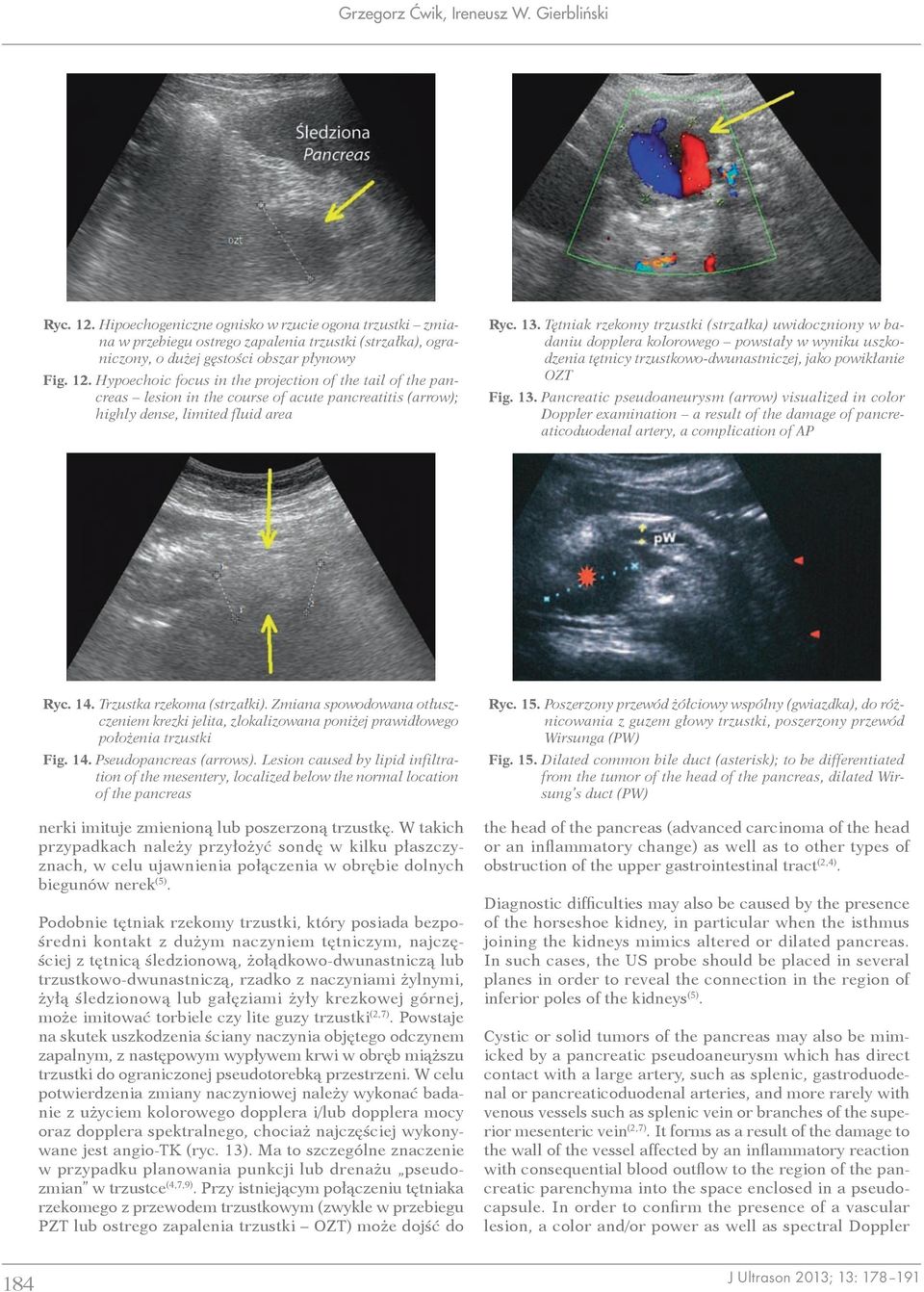 Hypoechoic focus in the projection of the tail of the pancreas lesion in the course of acute pancreatitis (arrow); highly dense, limited fluid area Ryc. 13.