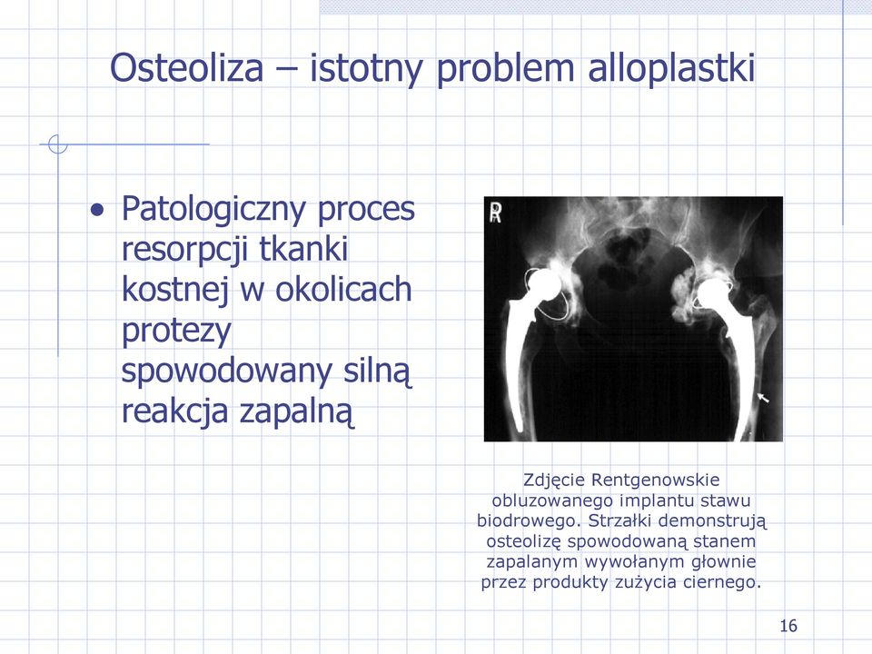 Rentgenowskie obluzowanego implantu stawu biodrowego.