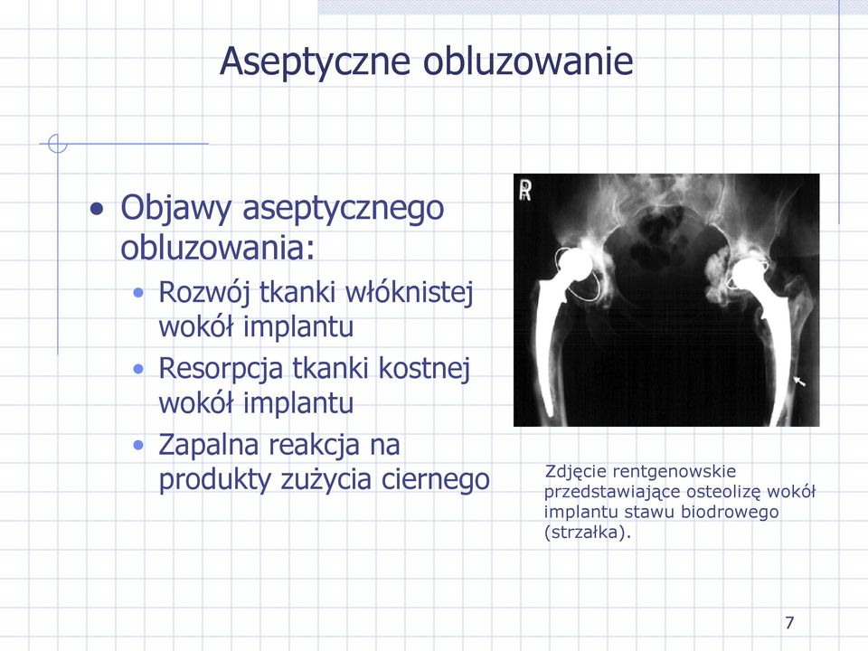 implantu Zapalna reakcja na produkty zużycia ciernego Zdjęcie