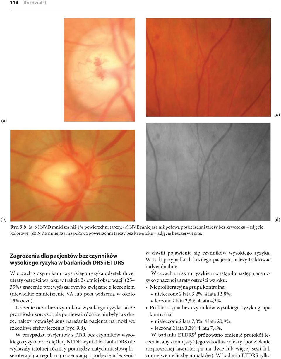 (d) Zagrożenia dla pacjentów bez czynników wysokiego ryzyka w badaniach DRS i ETDRS W oczach z czynnikami wysokiego ryzyka odsetek dużej utraty ostrości wzroku w trakcie 2-letniej obserwacji (25 35%)