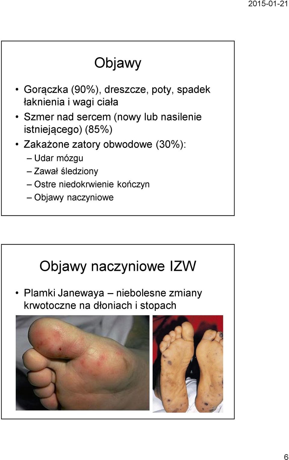 Udar mózgu Zawał śledziony Ostre niedokrwienie kończyn Objawy naczyniowe Objawy