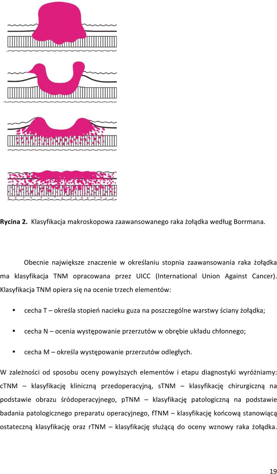 Klasyfikacja TNM opiera się na ocenie trzech elementów: cecha T określa stopień nacieku guza na poszczególne warstwy ściany żołądka; cecha N ocenia występowanie przerzutów w obrębie układu chłonnego;