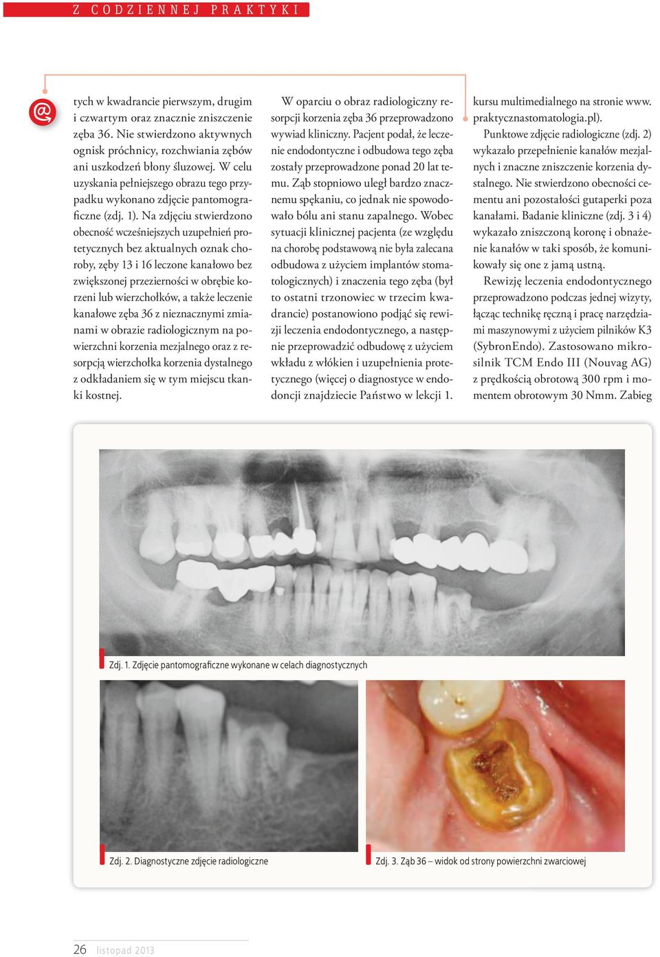 Na zdjęciu stwierdzono obecność wcześniejszych uzupełnień protetycznych bez aktualnych oznak choroby, zęby 13 i 16 leczone kanałowo bez zwiększonej przezierności w obrębie korzeni lub wierzchołków, a