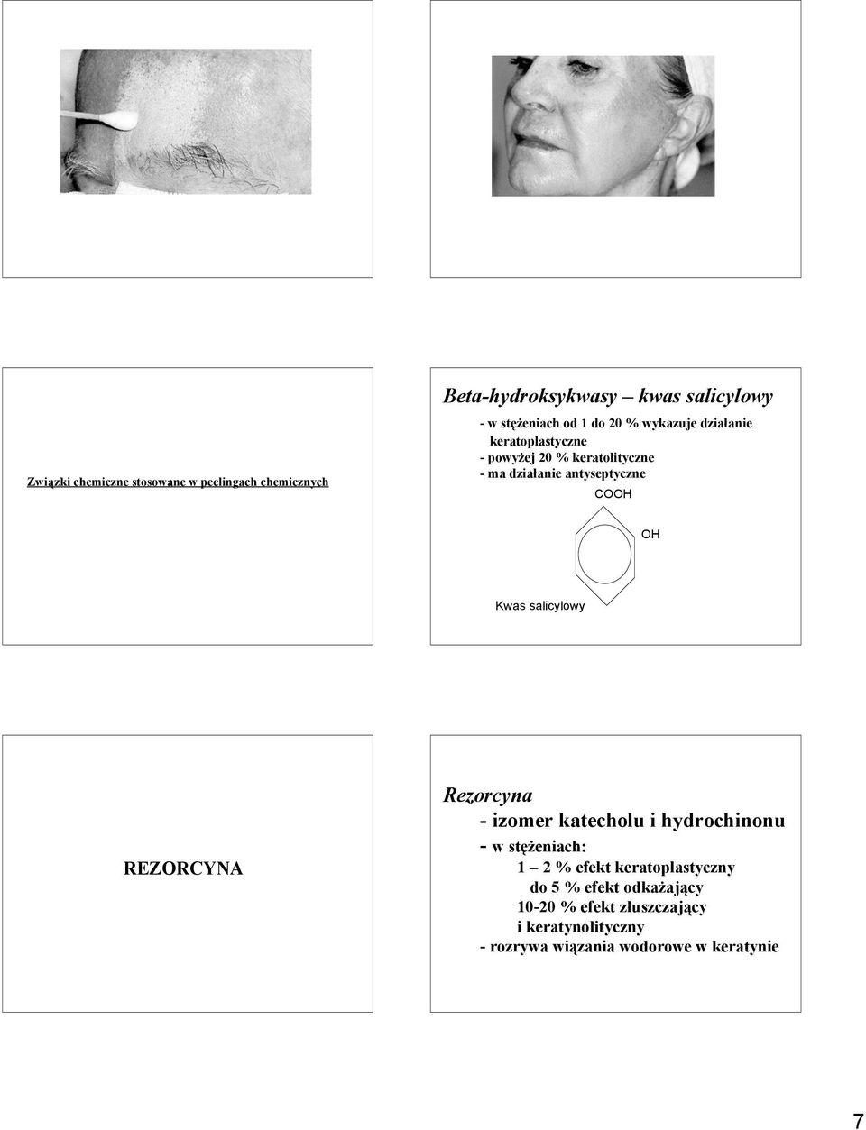Kwas salicylowy REZORCYNA Rezorcyna - izomer katecholu i hydrochinonu - w stężeniach: 1 2 % efekt